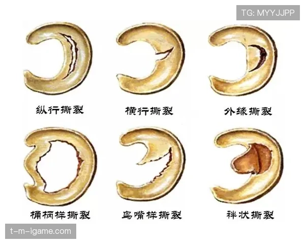 加维半月板损伤情况解析 加维半月板损伤情况解析